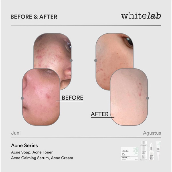 WHITELAB Acne Series | Untuk Kulit Lembap Dan Bebas Jerawat Dengan Mugwort, Tea Tree, BHA [BPOM]