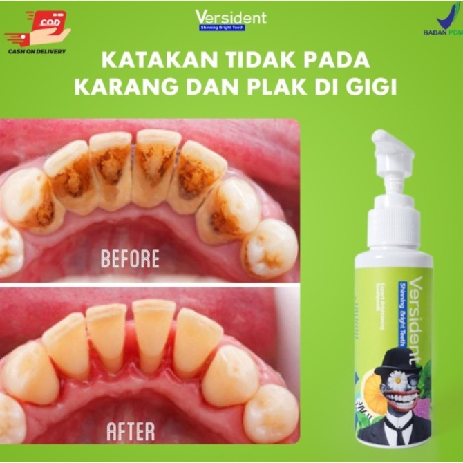VERSIDENT Shinning Bright Teeth | Pemutih Gigi  Pembersih Karang Gigi, Mengatasi Bau Mulut Original BPOM