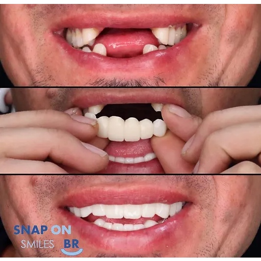 ORI TERMURAH Gigi Palsu Atas Bawah Original snap on smile Gigi palsu permanen kuat tahan lama Veneer