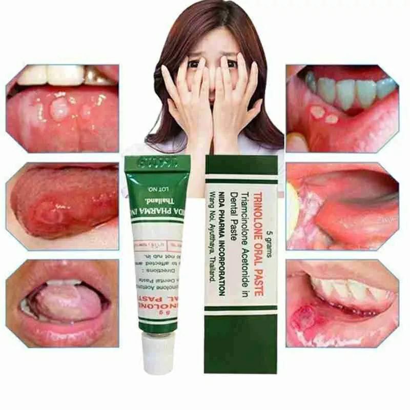 NIDA TRINOLONE ORAL PASTE - Salep Sariawan | Untuk Sariawan (Obat Sariawan) ORIGINAL THAILAND 5gr