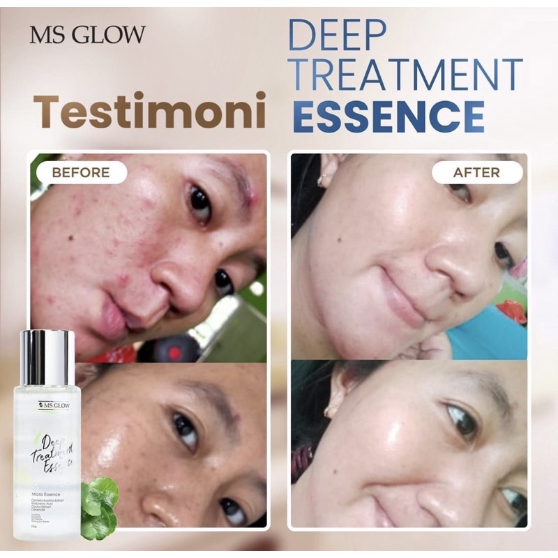 DEEP TREATMENT ESSENS CENTELLA MSGLOW MURAH
