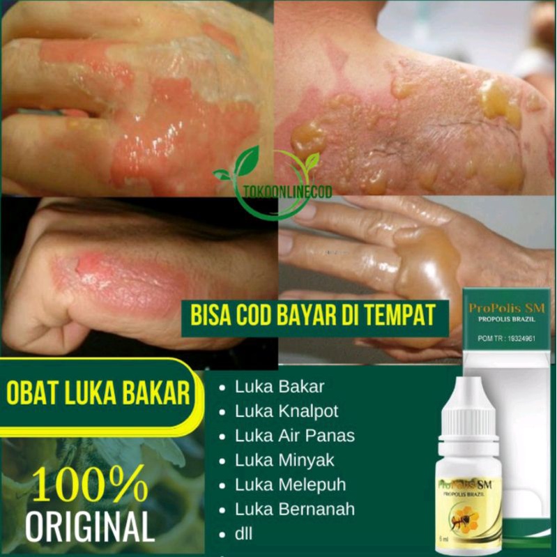 Obat Luka Bakar, Obat Luka Kenalpot Alami, Obat Bekas Luka Air