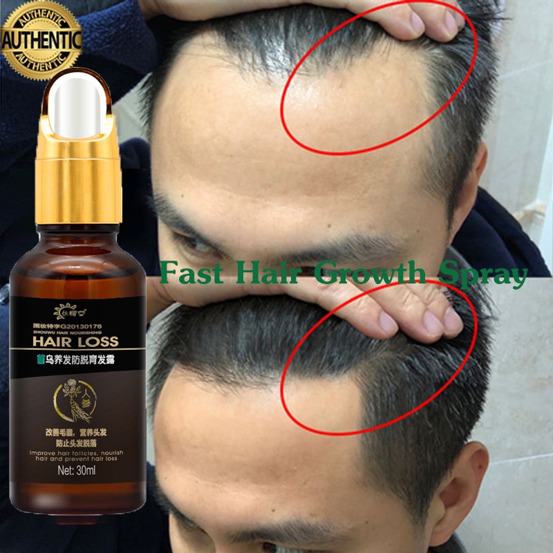 Penumbuh rambut botak Serum rambut rontok 30ml Penumbuh rambut cepat Kontrol minyak Menyuburkan ramb