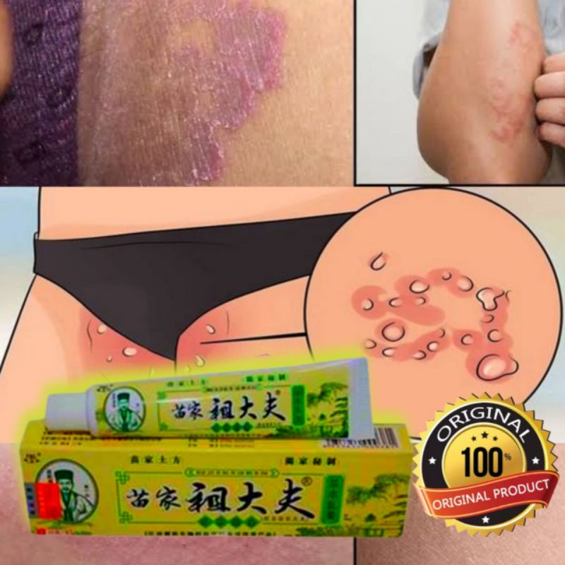 Salep Krim Gatal Paling Ampuh Alami Ramuan Cina Original