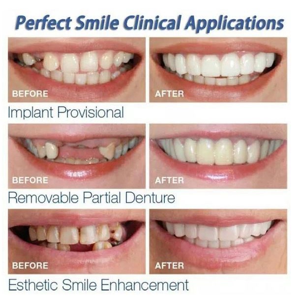 Snap On Smile Veneer Instan Gigi Palsu 1 Set Sepasang Gigi Atas Dan Bawah