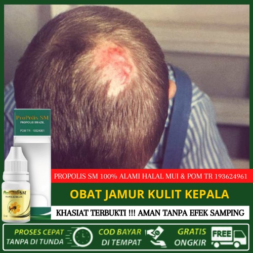 Obat Jamur Kulit Kepala, Tinea Capitis, Infeksi Kulit Kepala, Ruam Kulit Kepala, Kulit Kepala Gatal,