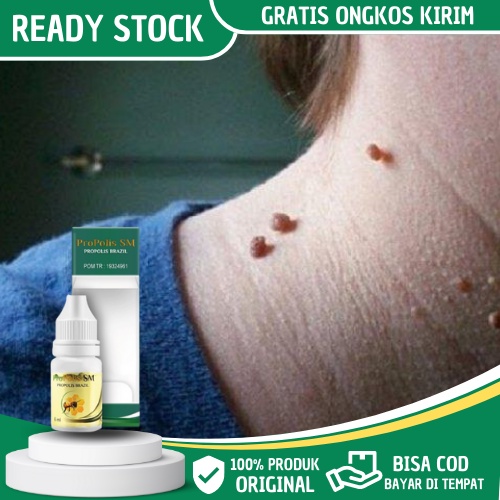 Obat Papiloma - Obat Kutil Papiloma - Obat Papiloma di Leher - Obat Penghilang Kutil - Obat Kutil di