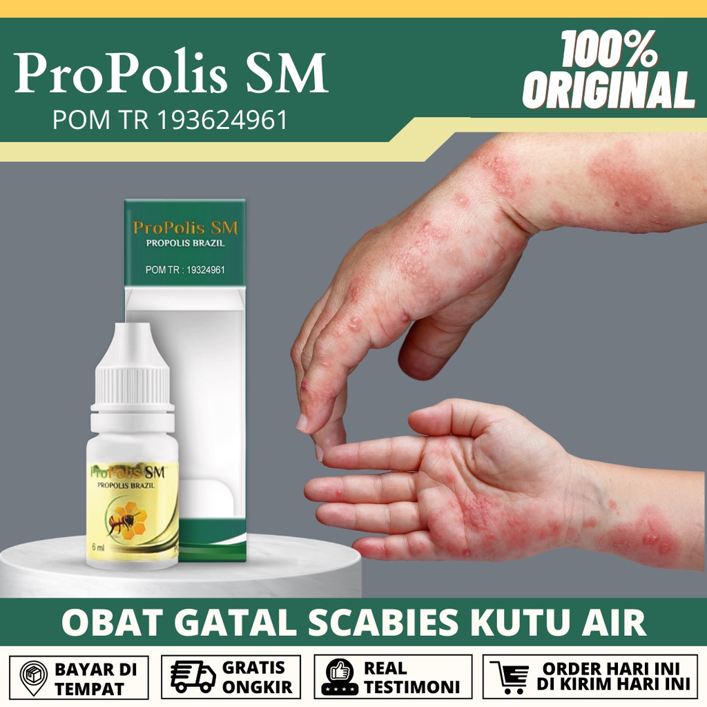 ProPolis SM Obat Salep Eksim Kering, Eksim Basah, Eksim Menahun, Gatel Kulit Panu Kurap Kutu Air Inf