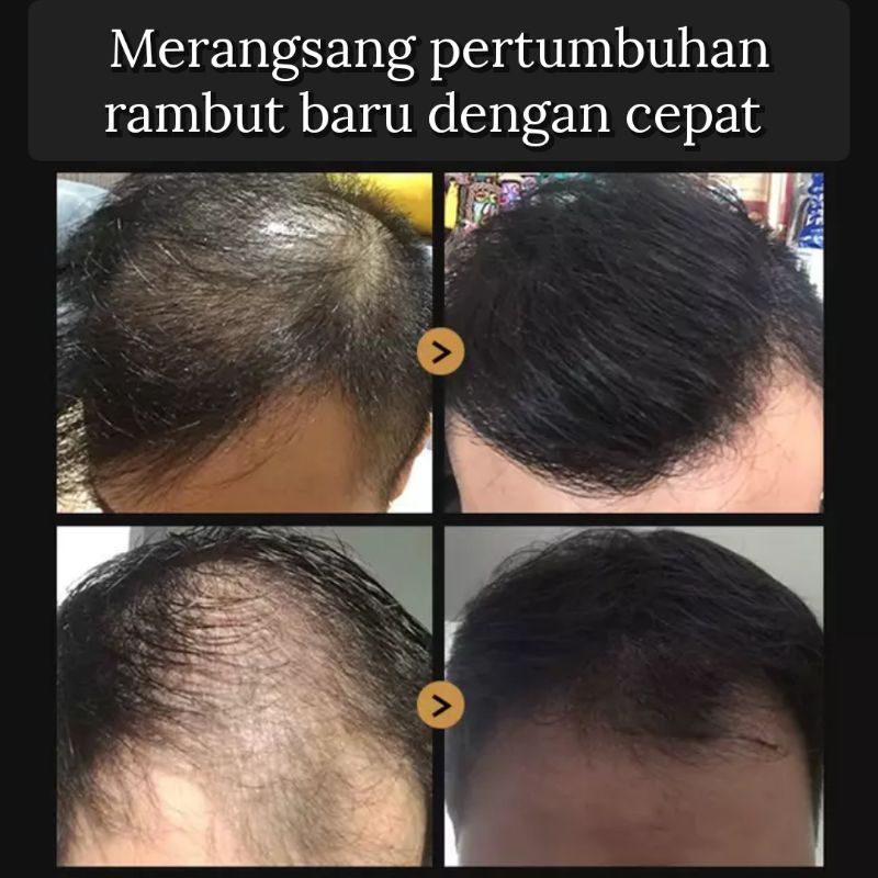 SEEMSURE GROWTH SERUM penumbuh rambut botak anti rontok aminexil spa