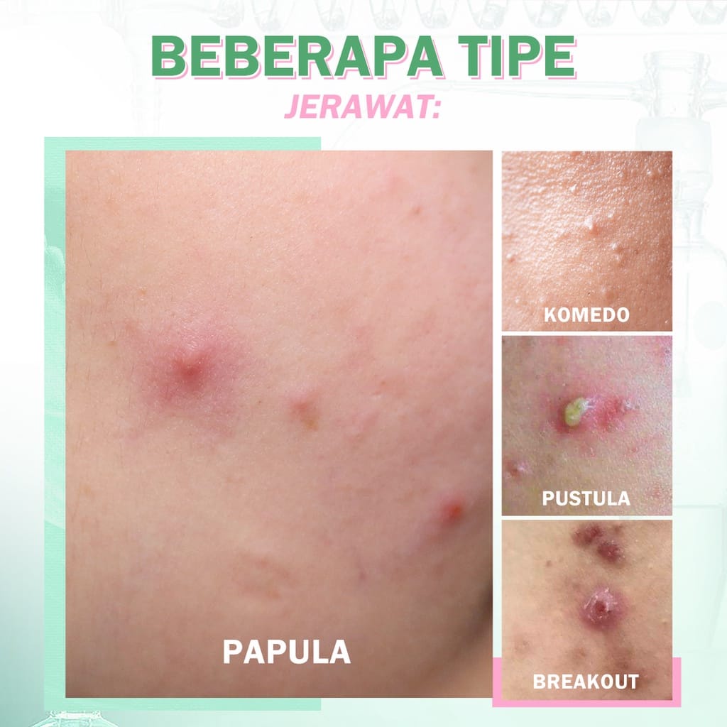 ✿ELYSABETHME✿  BNB BARENBLISS pimple warrior salicylid acid acne DRYING LOTION - obat totol jerawat