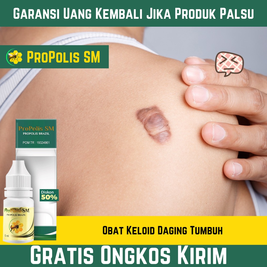 Obat Keloid Daging Tumbuh , Keloid Di Dada , Obat Keloid Menonjol Tahunan | PROPOLIS SM