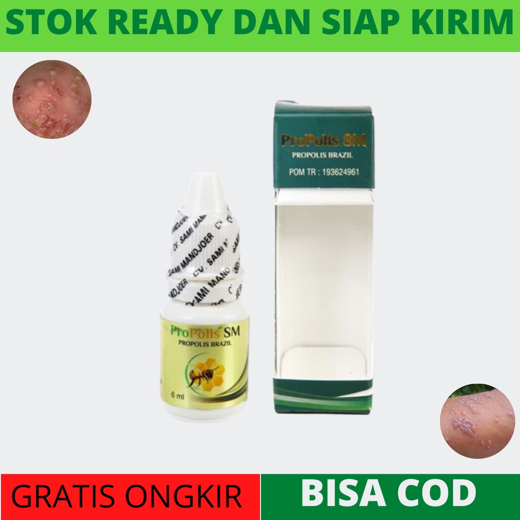 Obat Budug Bernanah Di Kaki, Obat Borok Bernanah Untuk Anak, obat Gatal Borok, Bernanah, Obat Budug 
