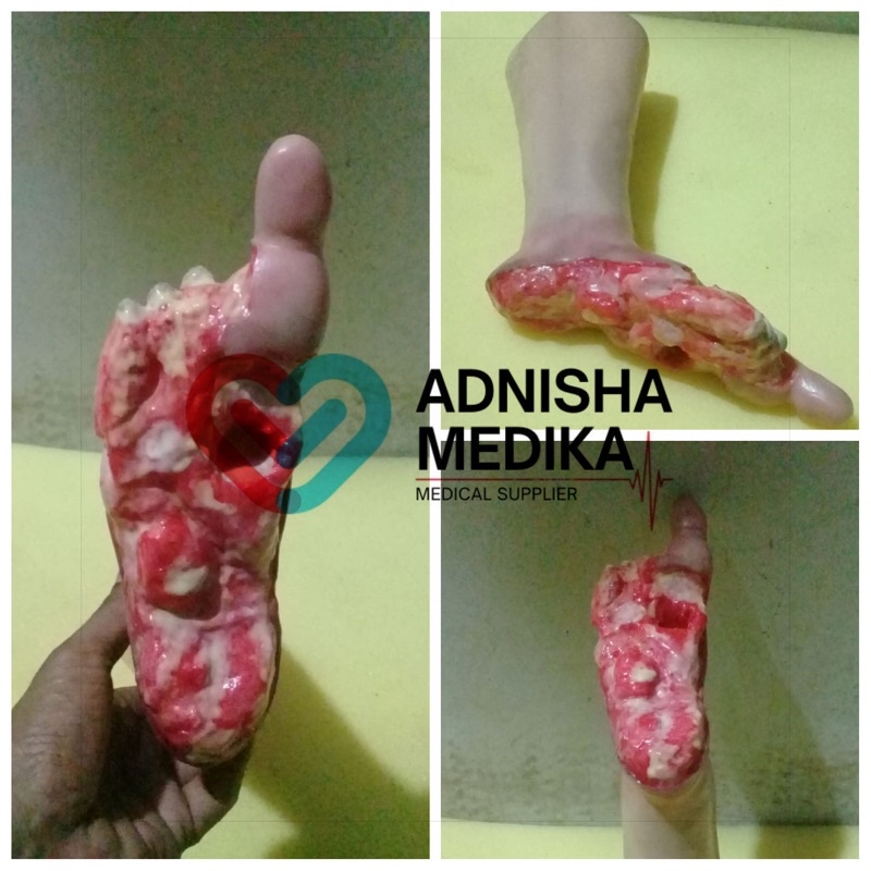 PHANTOM MANIKIN KAKI BOROK / KAKI DECUBITUS