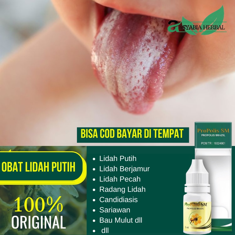 Obat Lidah Berwarna Putih - Bercak Putih Di Lidah - Lidah Putih Berjamur | PROPOLIS SM