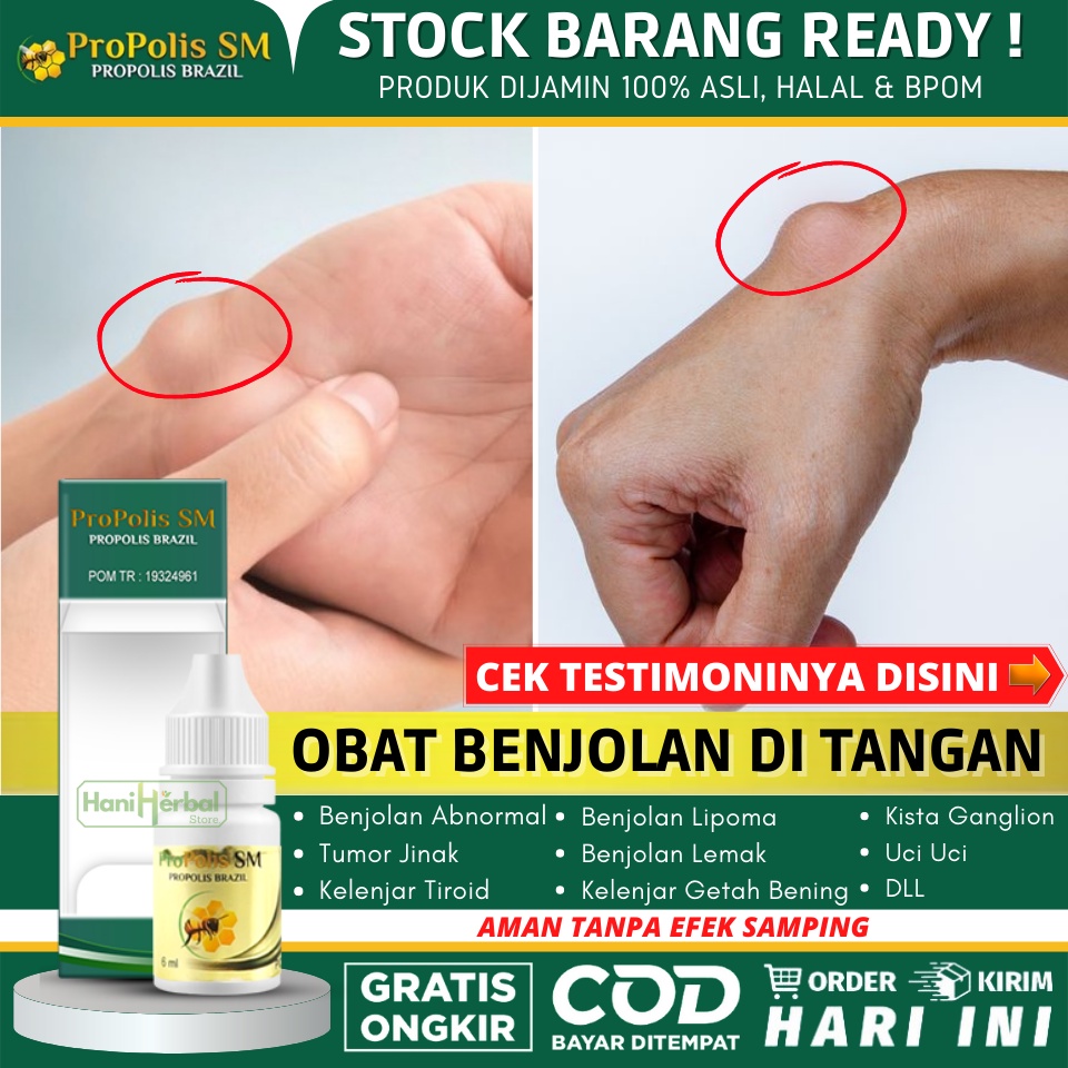 Obat Penghilang Benjolan di Tangan, Obat Benjolan Lipoma, Obat Benjolan Uci - Uci, Penghancur Kista 