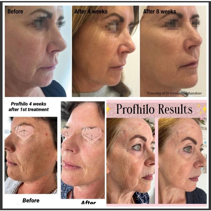 Profhilo/ Ultrahilo Skin Booster Korean/ Rejuran Skin Booster