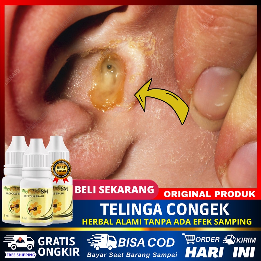 Jual Obat Tetes Telinga Congek Berair Dan Bau Gendang Telinga Bocor