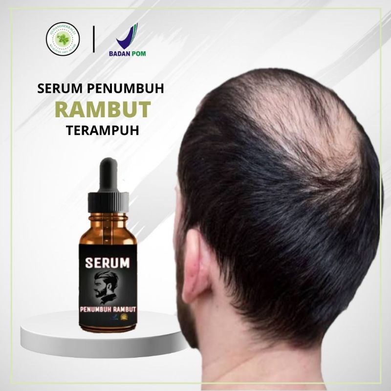 MINYAK PNUMBUH RAMBUT - SERUM PENUMBUH Penumbuh Rambut Secara Cepat / Obat Penumbuh Rambut Botak Sup