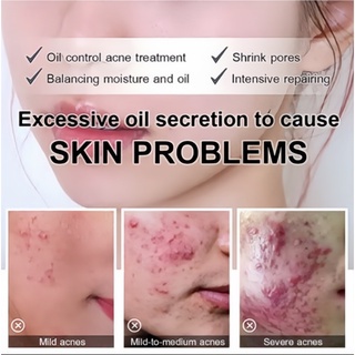 Krim Jerawat Pembersih Penghilang Jerawat Cream Jerawat Acne Cream 30g Membersihkan Kulit Secara Mendalam Menghilangkan Melanin Jerawat dan Bekas Jerawat Perawatan Kulit Unisex