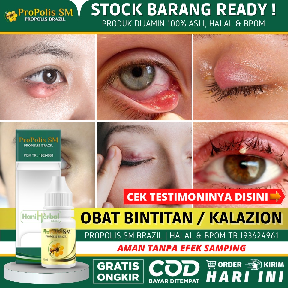 Jual Obat Oles Untuk Benjolan Bernanah Di Kelopak Mata Obat Bintitan Timbilen Cindil Obat