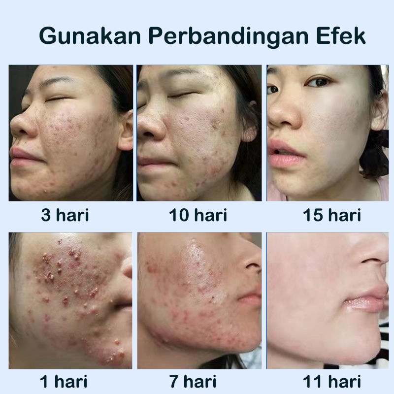 【ORANNLE】[100% Asli] Cream jerawat obat totol jerawat krim jerawat obat jerawat dan bekas jerawat Jerawat Removal of Acne Cream Untuk Pria dan Wanita