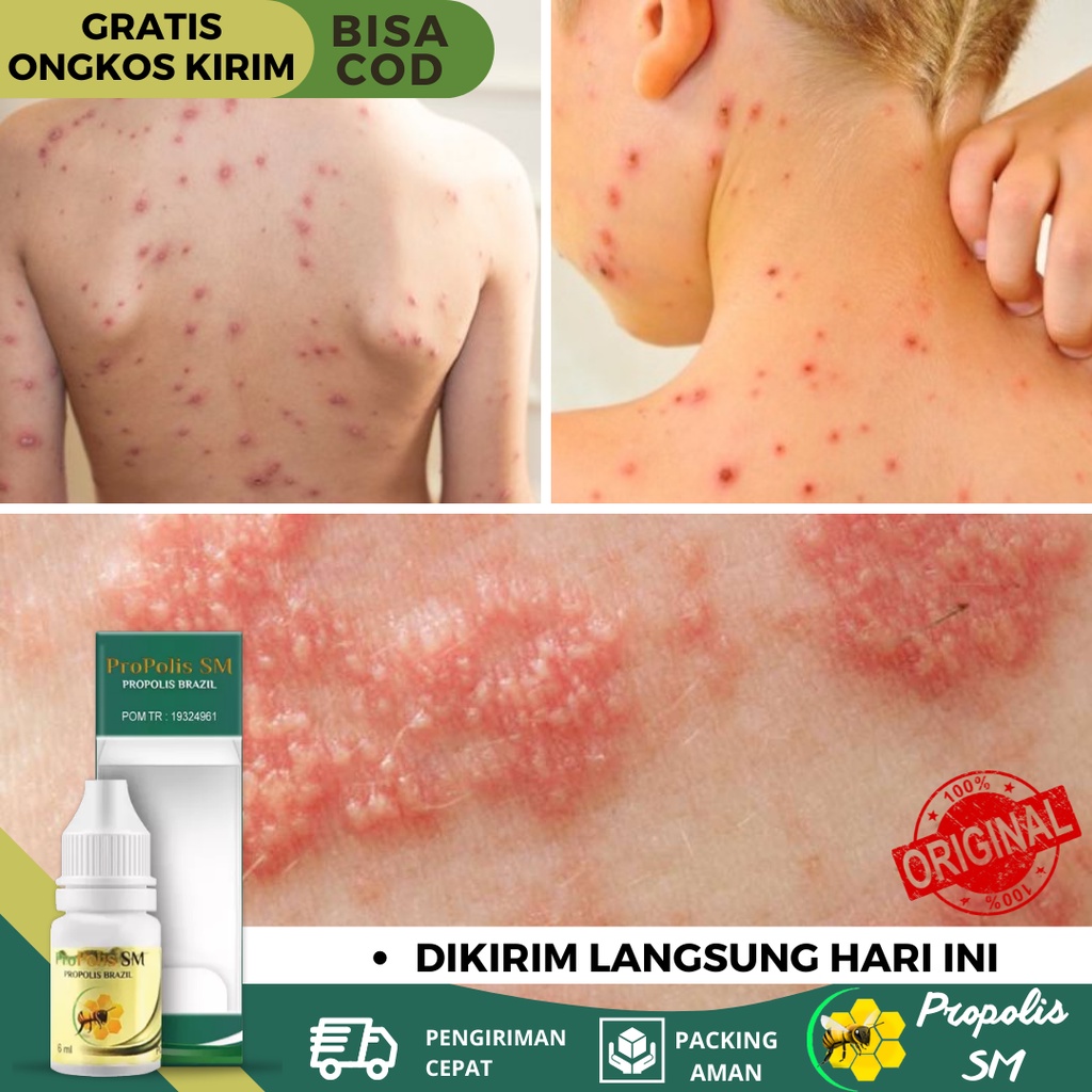 Obat Cacar Kulit, Obat Cacar Air, Obat Cacar Api, Obat Cacar Ular, Obat Rubeola, Obat Cenang Di Kuli