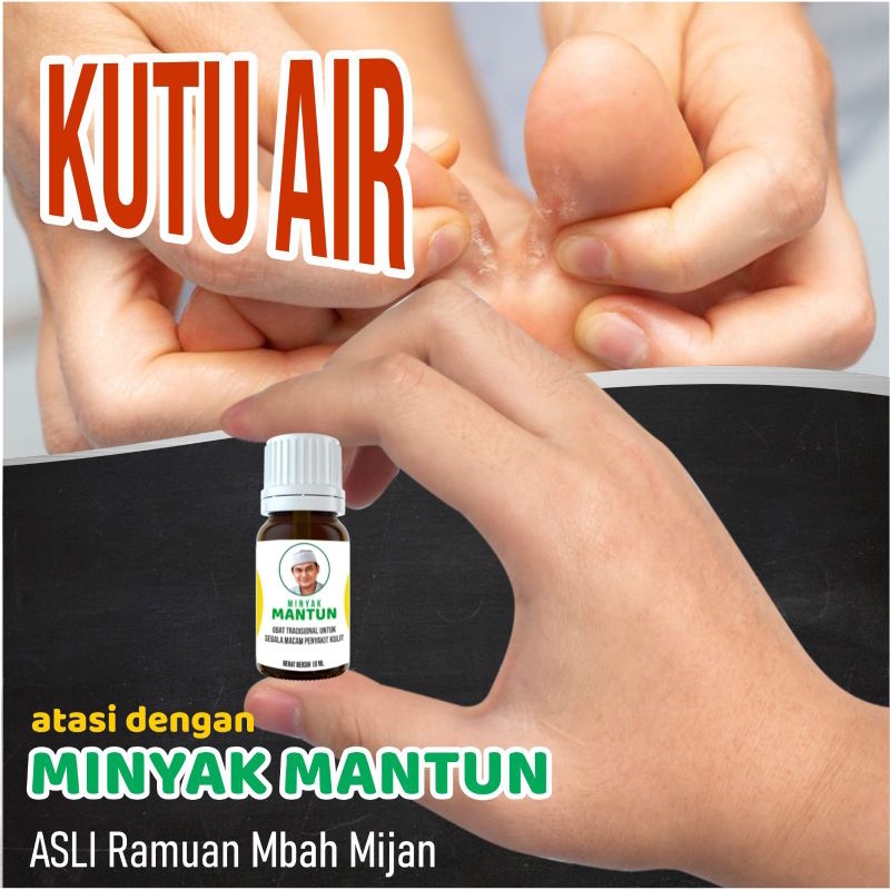 Minyak Mantun Herbal Penyakit Kulit