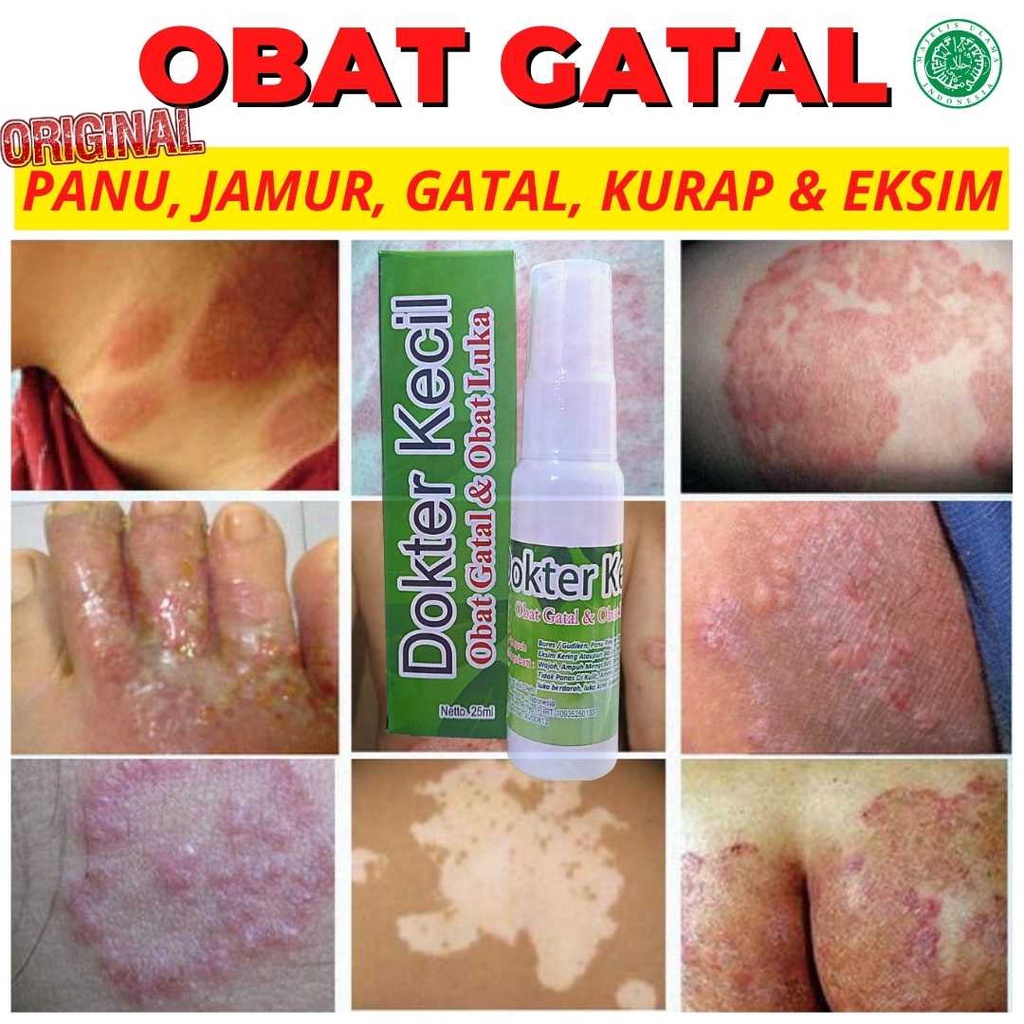 Obat Gatal Gatal Kulit Selangkangan, Kurap, Kudis, Eksim, Kering dan Basah, Jamur, Kutu Air dan Jera