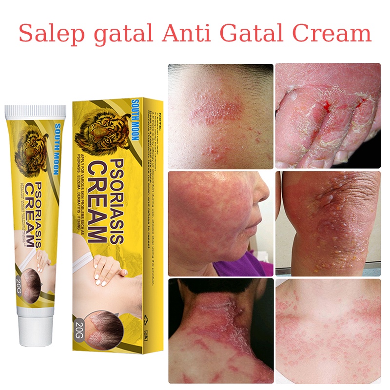 Salep Gatal Salep Kulit Krim Psoriasis Cream Mengobati Eksim dermatitis Kurap Kulit Kudis Bintik Mer