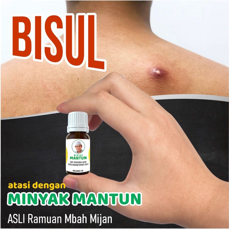 Minyak Mantun Herbal Penyakit Kulit