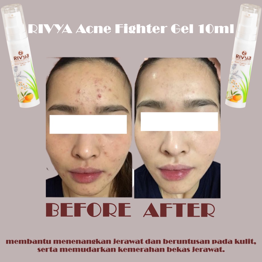 RIVYA Acne Fighter Gel 10ml BPOM - Amaze_Kosmetik