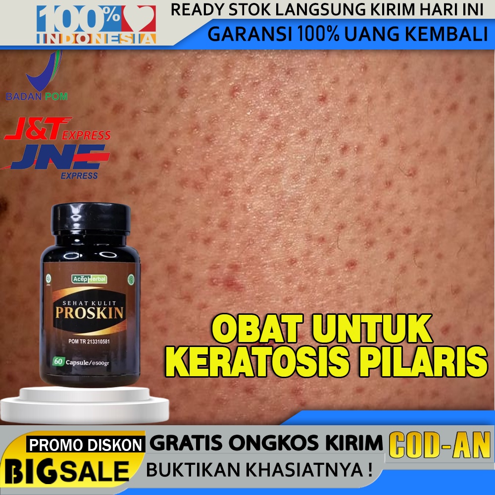 Jual Obat Keratosis Pilaris Penyakit Kulit Ayam Kulit Gatal Terasa Kering Dan Kasar Bintik