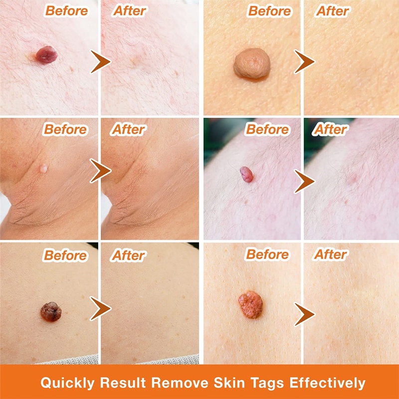 【20 gr】Skin Tag Remover Cream/Salep Obat Penghilang Tahi Lalat dan Kutil/Krim Pengilang Kutil/Wart Removal Cream
