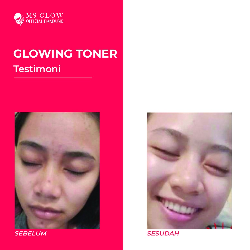 MS Glow Toner Glowing / Toner Glowing Ms Glow