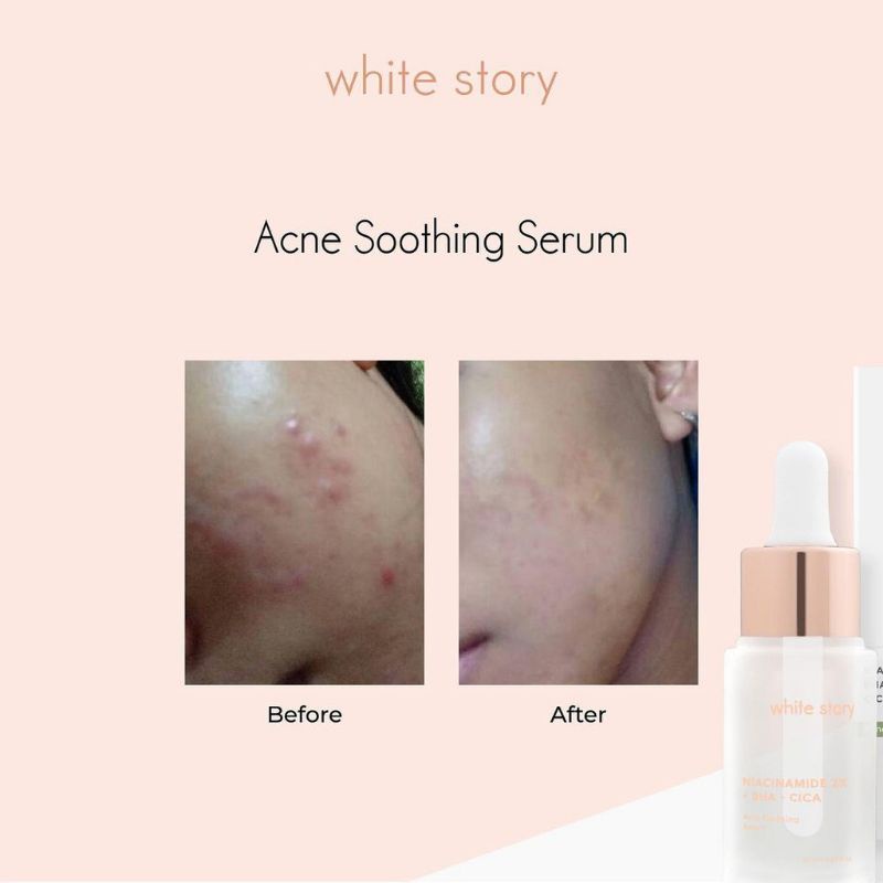 WHITE STORY Acne Soothing Serum 20ml