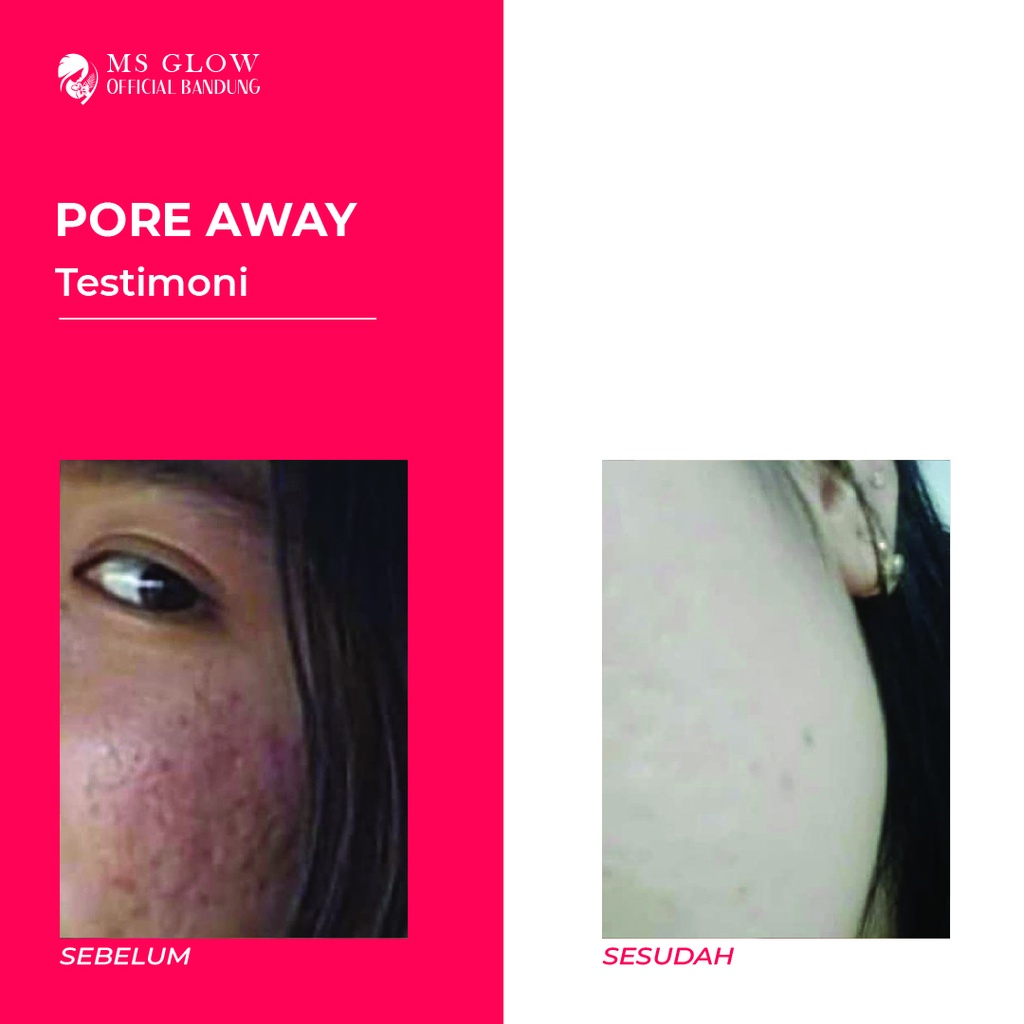 Pore Away MS Glow Perawatan Wajah Spot Treatment Berkualitas Termurah - By Msglowofficialbandung