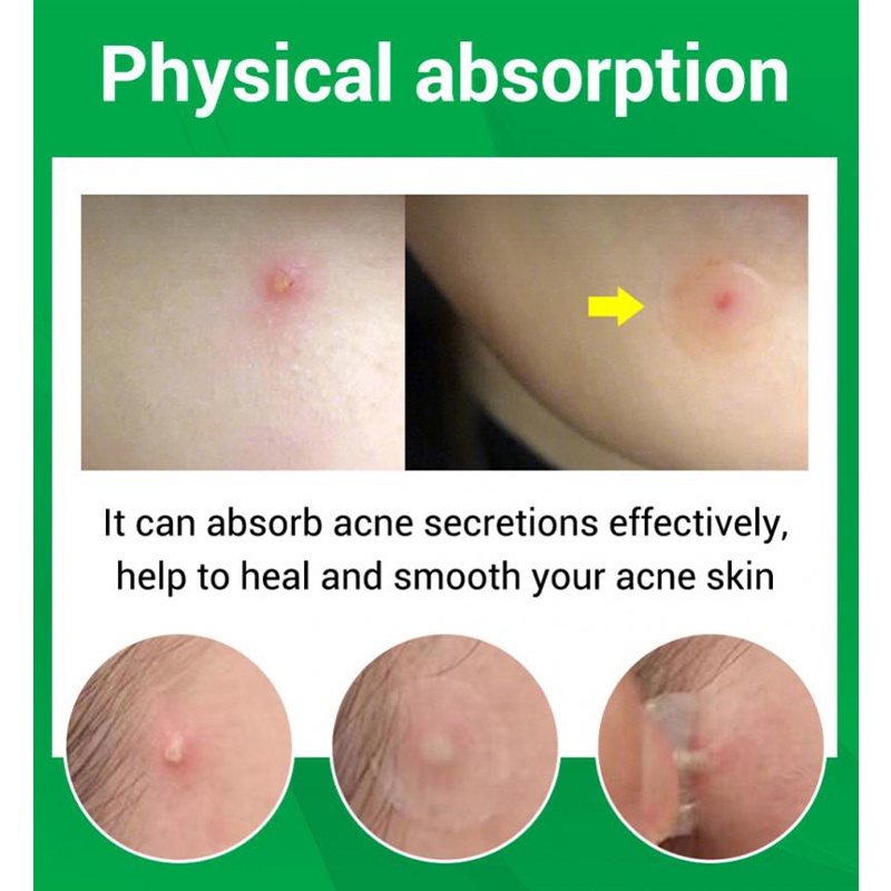 Acne Pimple Patch/Patch Jerawat Anti Jerawat/Stiker Penghilang Jerawat(36 Patches)