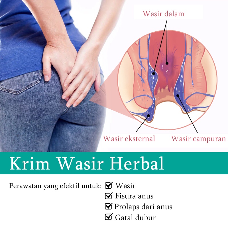 Obat wasir Salep wasir Krim wasir 20G Obat herbal alami, aman dan tidak berbahaya, cepat dan efektif menghilangkan wasir, menghilangkan benjolan, wasir dalam, wasir luar, wasir campuran, gatal pada anus, luka pada lubang anus