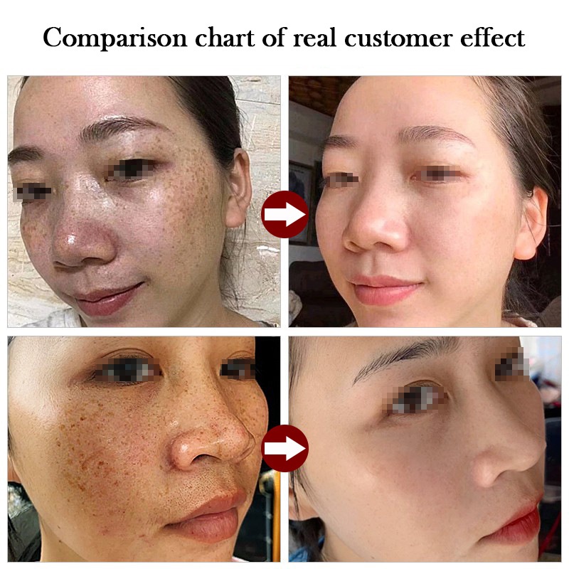 {barang kualitas}Whitening Freckle Cream Remove Dark Spots Anti Freckle Cream Niacinamide Fade Pigmentation Melasma Brighten Creams【 Free Delivery+ COD + dikirim dalam 24 jam】