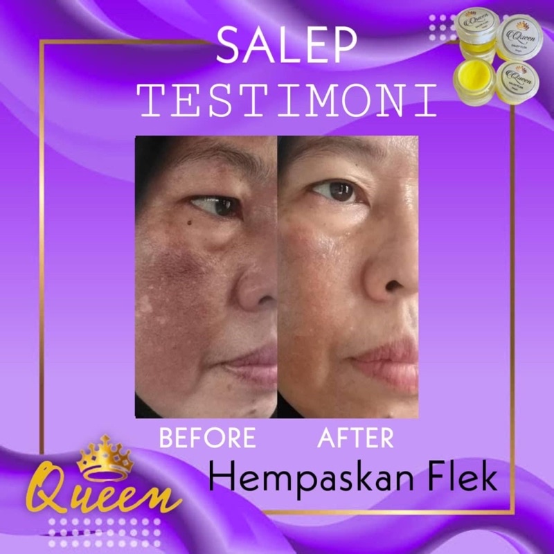 BISA (COD) QUEEN SALEP MAGIC FLEK DAN ACNE