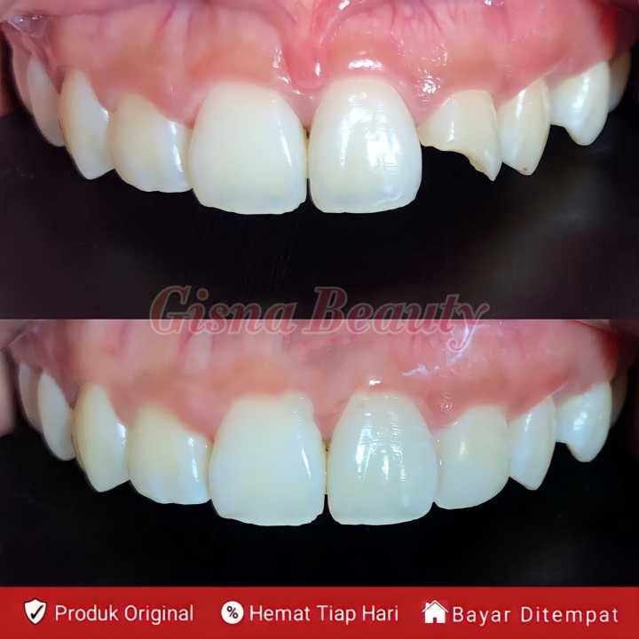 SANGAT KUAT  PENAMBAL GIGI OMPONG PERMANEN ORIGINAL Gigi palsu penutup ompong asli permanen Penutup 