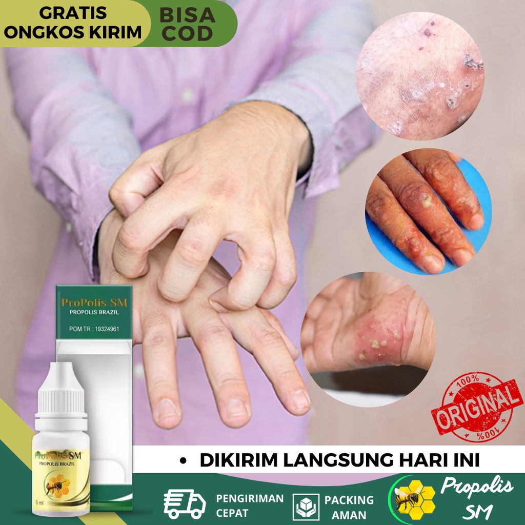 Obat Borok, Obat Budug Gatal, Obat Budug Bernanah, Obat Herbal Budugan Koreng, Obat Budugan Seluruh 