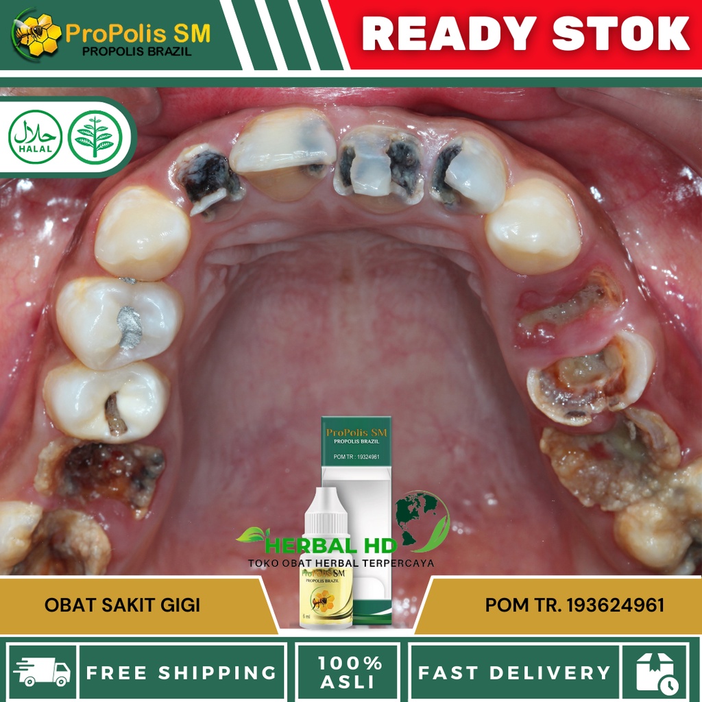 Obat Tetes Sakit Gigi - Obat Kumur Sakit Gigi - Obat Tetes Gigi Berlubang - Obat Tetes Gigi Bengkak 