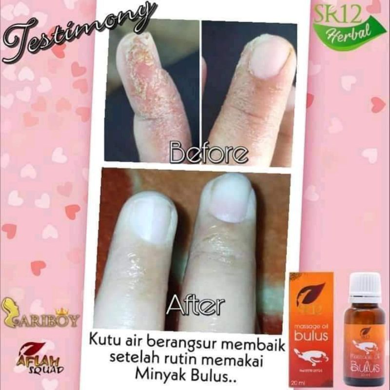 obat kutu air,panu,gatal,kaki pecah-pecah dan masih banyak lagi