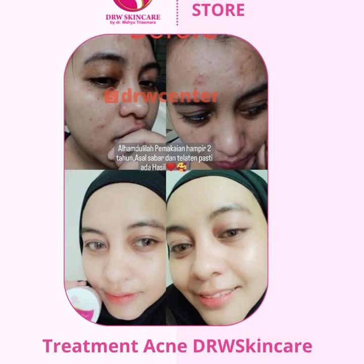 Paket Cream Glowing Pencerah, Penghilang Flek Membandel, Penghilang Jerawat/ Acne Radiant Drw Skinca