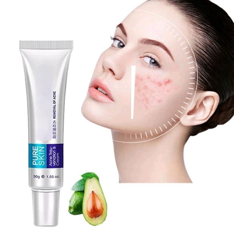 [ ORIGINAL ] Obat Penghilang Jerawat Dan Bekas Jerawat Ampuh Pure Skin Cleanser Cream Acne