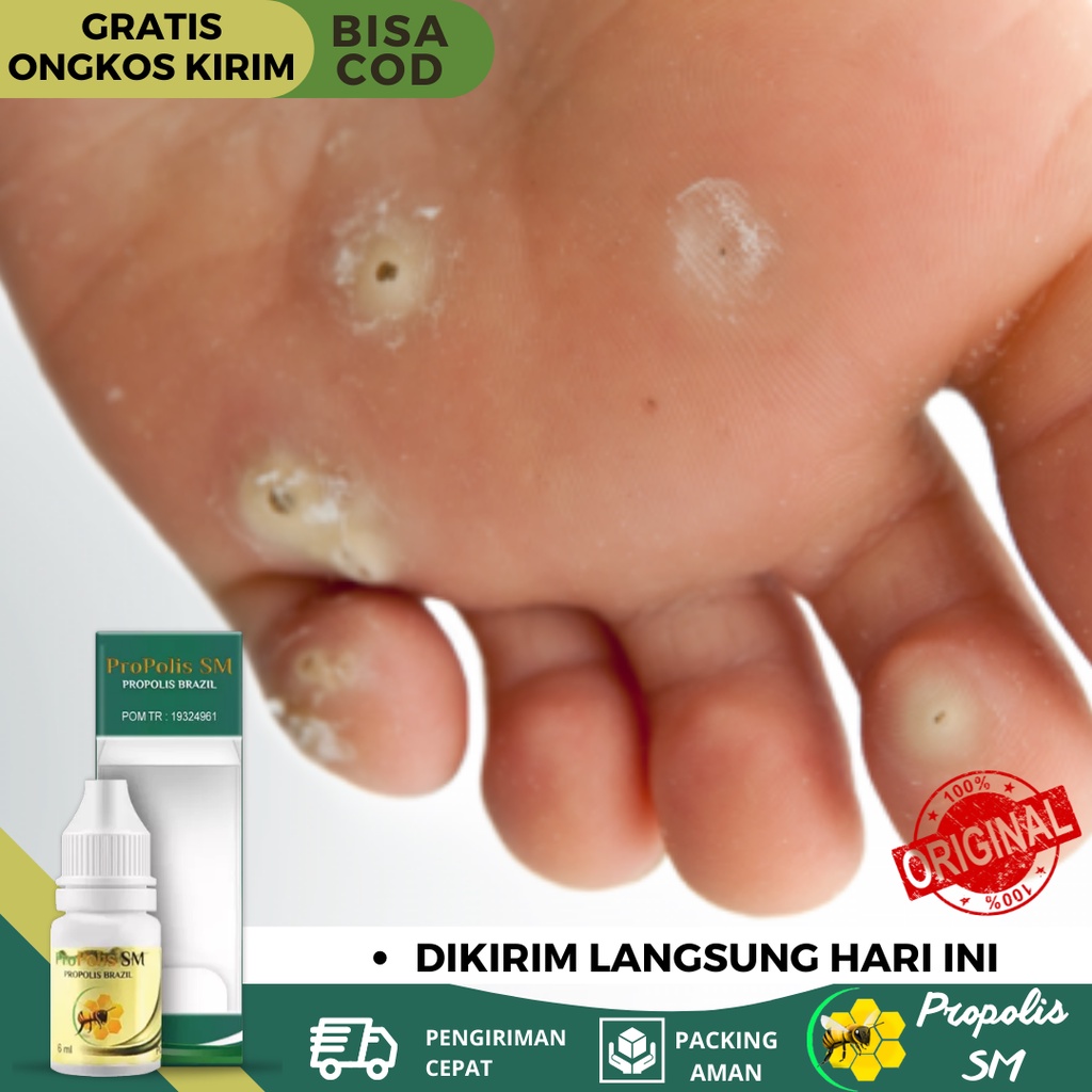 Obat Mata Ikan, Obat Mata Ikan Telapak Kaki, Obat Penghilang Mata Ikan Di Telapak Kaki, Obat Pengeri