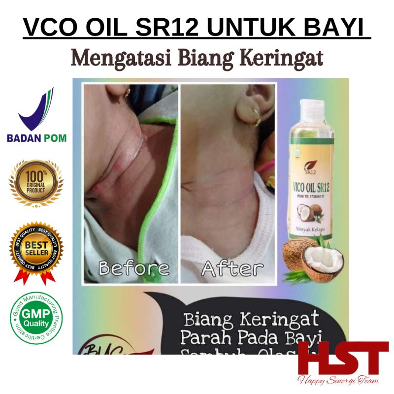 VCO oil SR12 untuk bayi Membantu Mengatasi Biang keringat