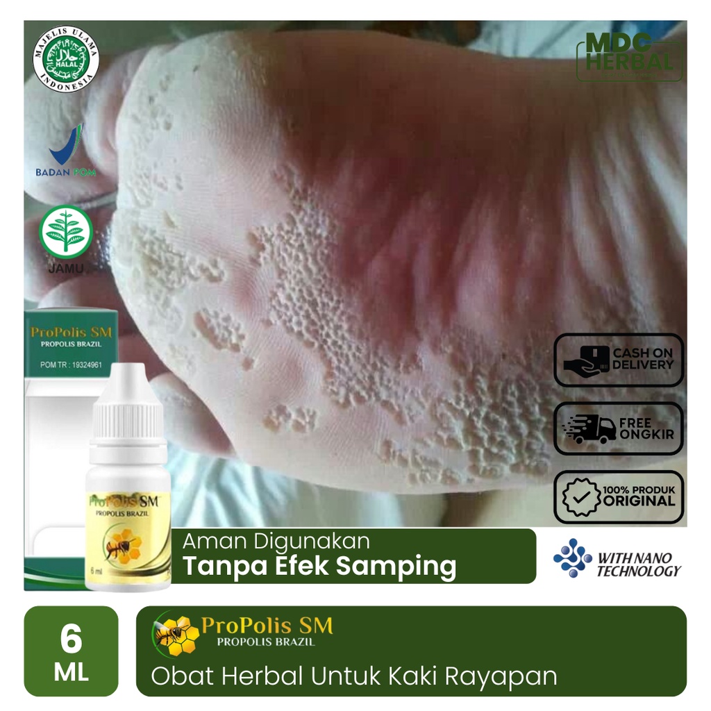 Obat Kaki Rayapan Telapak Kaki Bolong-Bolong Kutu Air Kaki Pecah Pecah Kering Berlubang dan Bau - PR