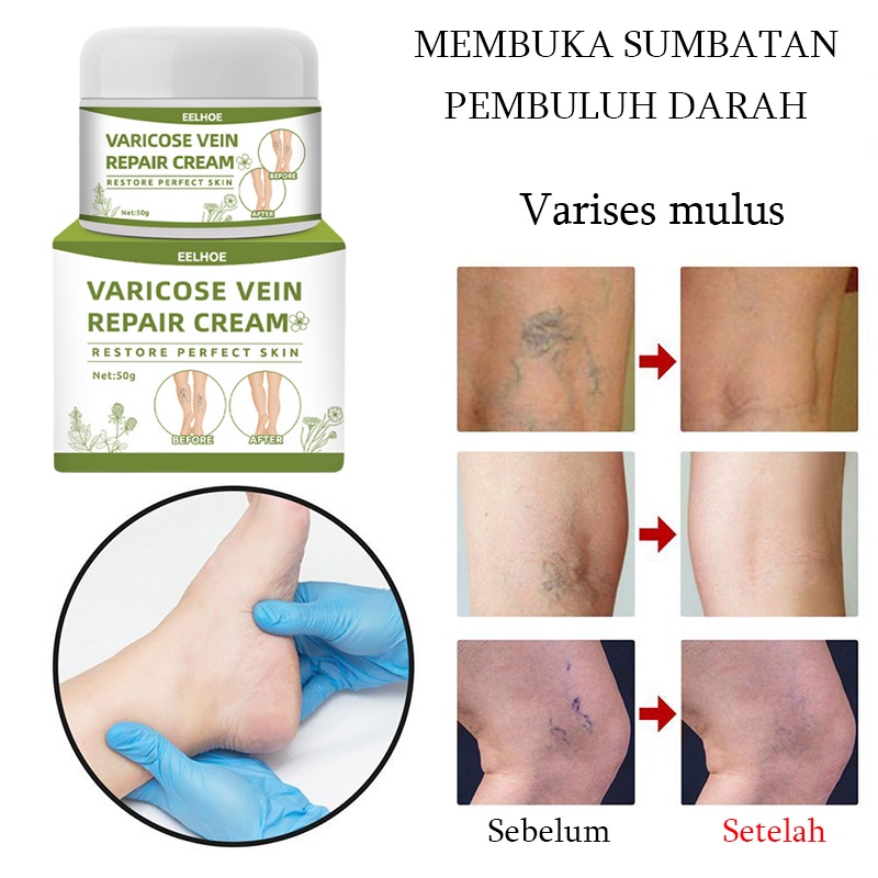 Obat varises Varises Cream obat varises paling ampuh Salep Penghilang Bekas Penghilang Varises Cream Salep Varises Herbal salep laba-laba Vaskulitis Flebitis Pengobatan Vaskulitis Salep Flebitis Vaskulitis Perawatan